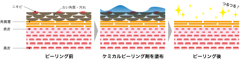 ケミカルピーリングイラスト