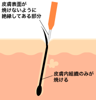 電気脱毛