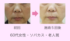 フォトフェイシャル施術例写真