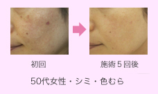 フォトフェイシャル施術例写真