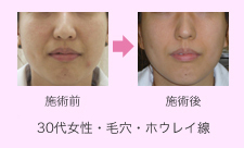 フォトフェイシャル施術例写真