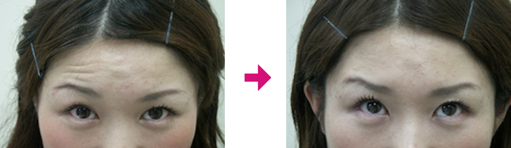 ボトックス注射で小顔に変身