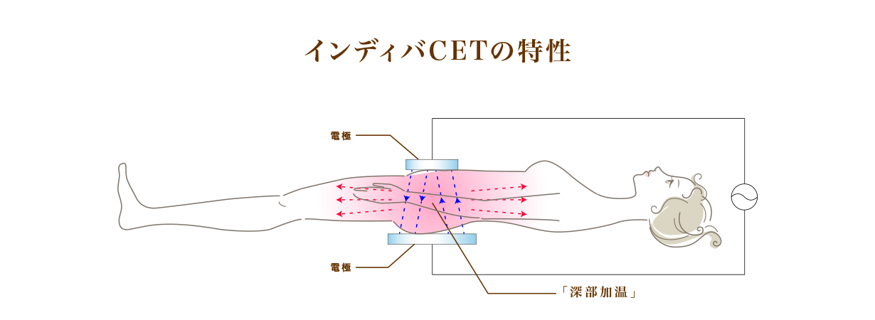 インディバCET