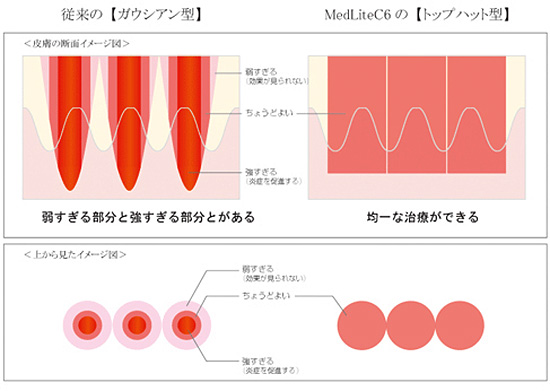 レーザートーニング